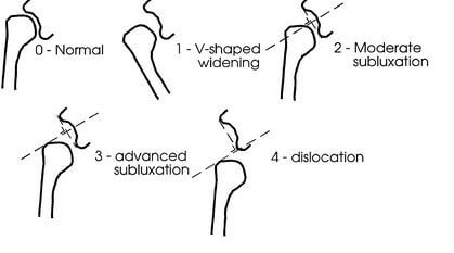 Shoulder subluxation Types