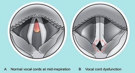 vocal cord dysfunction