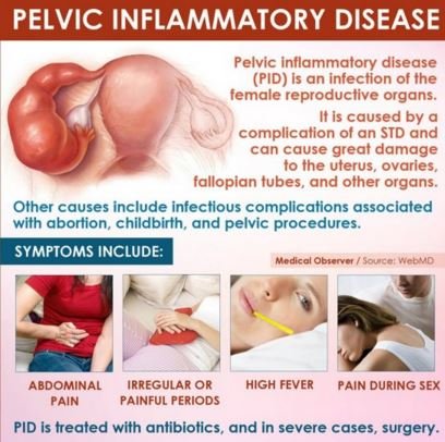 Pelvic Inflammtory Disease image