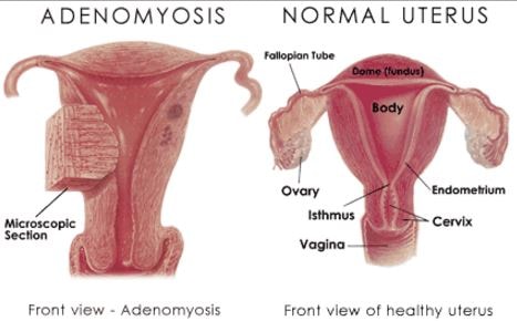 adenomyosis