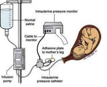 amnioinfusion