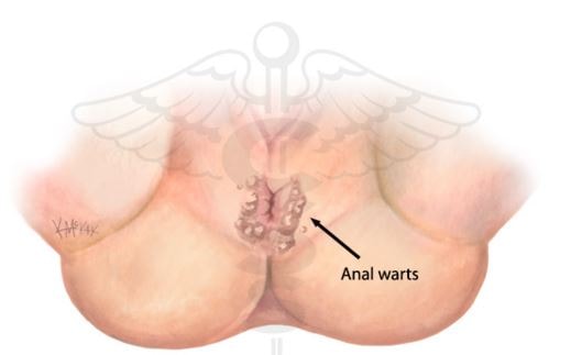 anal warts location