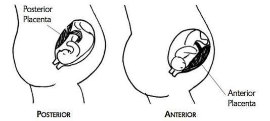 anterior-placenta-risks-complications-symptoms-causes