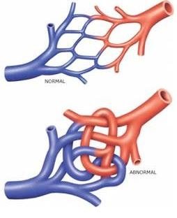 arteriovenous malformation