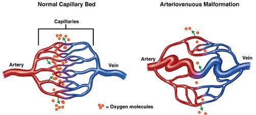 avm arteriovenous malformation