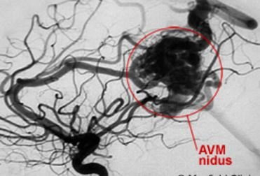 avm nidus coils