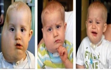 before and after lymphatic malformation