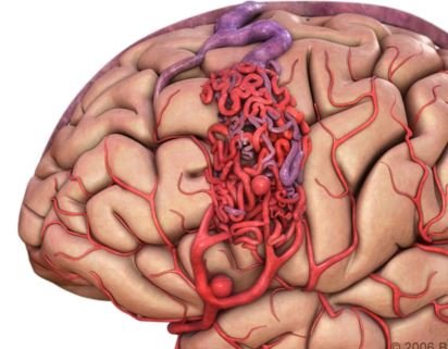 cerebral arteriovenous malformation