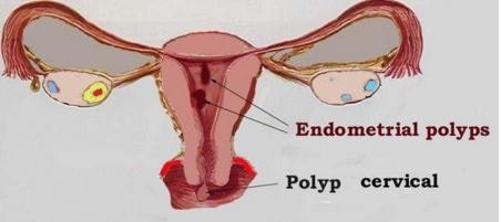 Image result for benign endocervical polyp