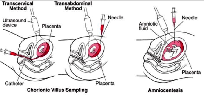 chorionic-villus-sampling-what-is-definition-risks-procedure