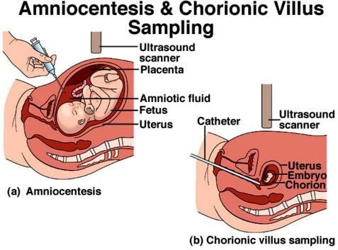 chorionic villus sampling technique risks results indications