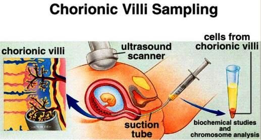 chorionic villus sampling