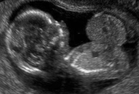 colour doppler ultrasound scan showing omphalocele picture