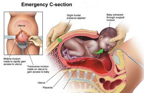 emergency c section