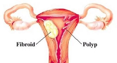 endometrial polyp
