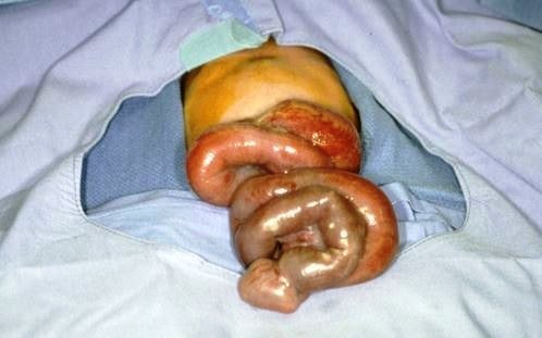 gastroschisis images