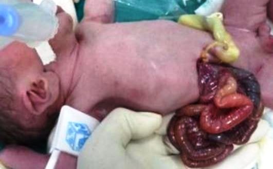 gastroschisis intestines newborns