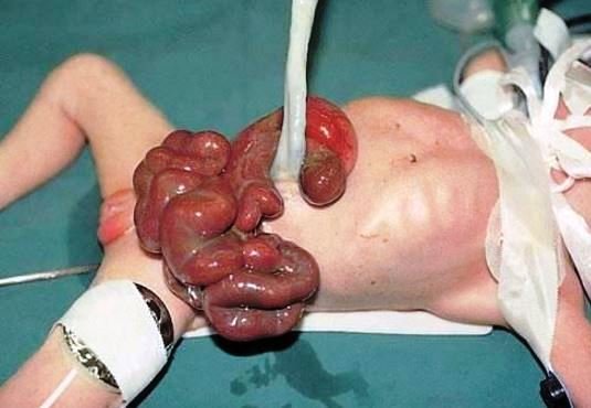 gastroschisis photo