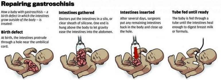 gastroschisis repair steps and procedure