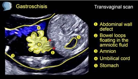 gastroschisis ultrasound color doppler