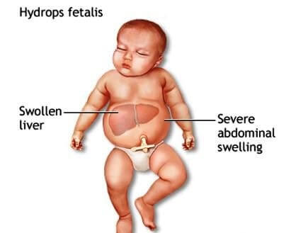 hydrops fetalis symptoms