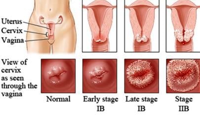 inflamed cervix stages