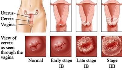 inflamed cervix stages