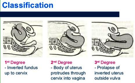 inverted uterus classification