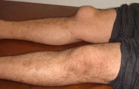 Bursitis Knee inflammation swelling