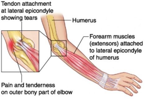 lateral epicondylitis image