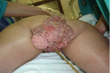 images of anus warts