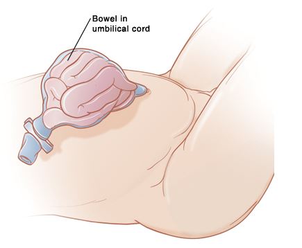 omphalocele bowel in umbilical cord