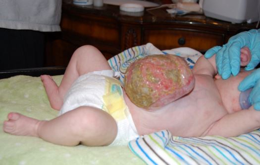 omphalocele in infants new borns image