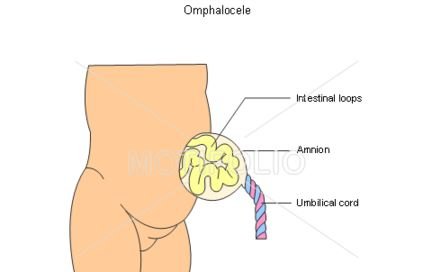 omphalocele pictures