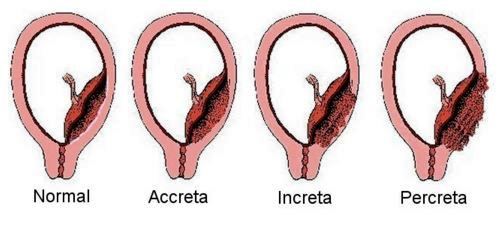 placenta accreta increta percreta types image