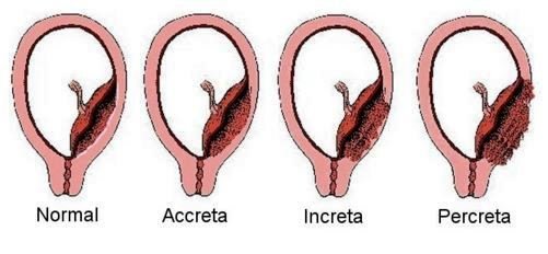 placenta accreta increta percreta types image