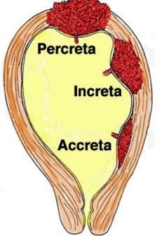 placenta accreta types percreta