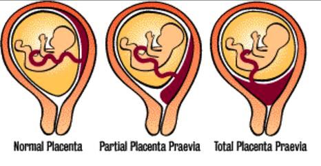 placenta previa image