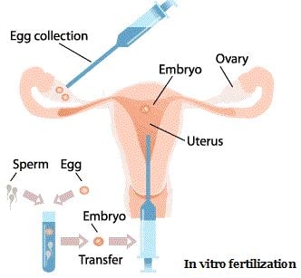 premature ovarian failure infertility invitro fertilization