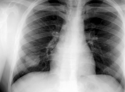 pulmonary arteriovenous malformation