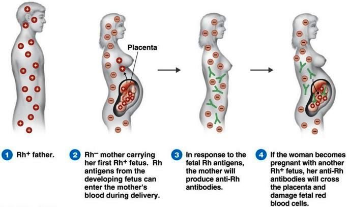 rh incompatibility symptoms causes complications diagnosis