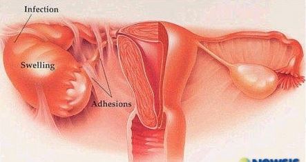 salpingitis adhesions, fallopian tube infection