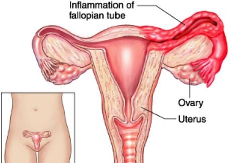 salpingitis picture