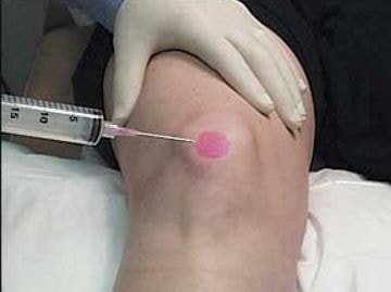 steroid injections for knee bursitis n diseases