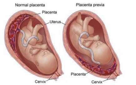 vasa previa vs normal placenta