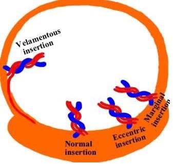 velementous cord insertion image