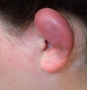 infected cartilage piercing