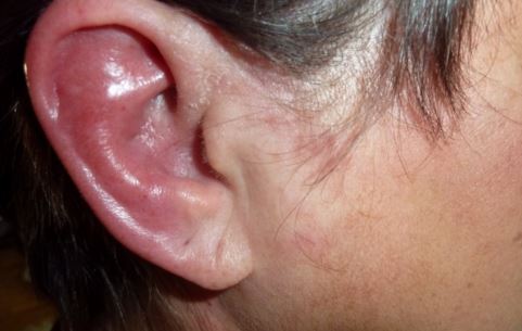 ear cartilage infection piercing image