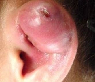 infected cartilage piercing