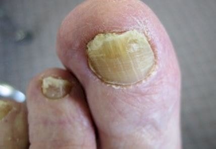 onychomycosis Pic